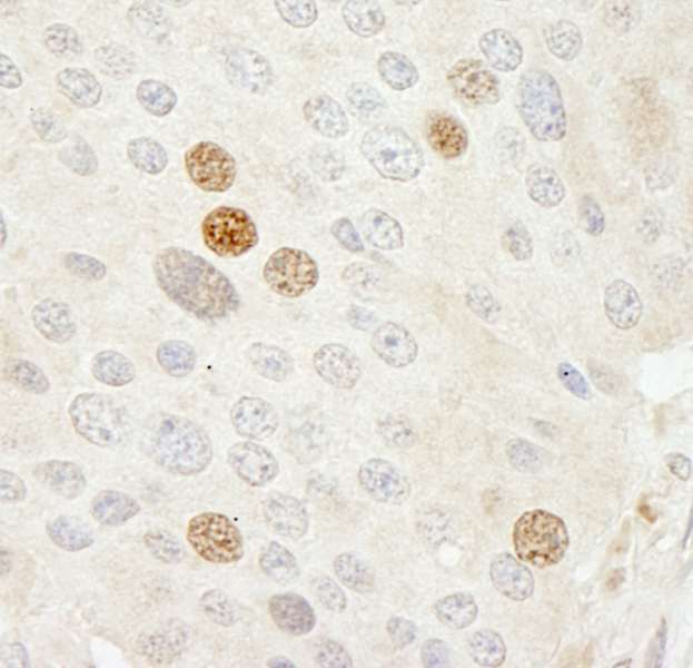 CDK2 Antibody - Detection of Human CDK2 by Immunohistochemistry. Sample: FFPE section of human pancreatic islet cell tumor. Antibody: Affinity purified rabbit anti-CDK2 used at a dilution of 1:250. Epitope Retrieval Buffer-High pH (IHC-101J) was substituted for Epitope Retrieval Buffer-Reduced pH.