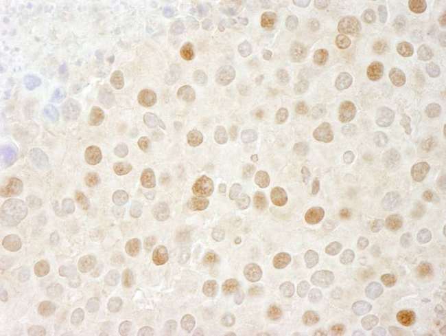 CDK2 Antibody - Detection of Mouse CDK2 by Immunohistochemistry. Sample: FFPE section of mouse renal cell carcinoma Antibody: Affinity purified rabbit anti-CDK2 used at a dilution of 1:250. Epitope Retrieval Buffer-High pH (IHC-101J) was substituted for Epitope Retrieval Buffer-Reduced pH.