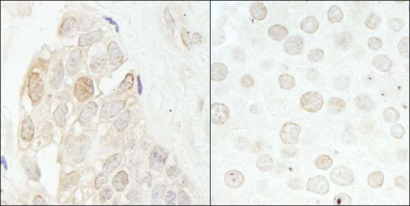 CDK2 Antibody - Detection of Human and Mouse CDK2 by Immunohistochemistry. Sample: FFPE section of human breast carcinoma (left) and mouse renal cell carcinoma (right). Antibody: Affinity purified rabbit anti-CDK2 used at a dilution of 1:1000 (1 ug/ml) and 1:5000 (0.2 ug/ml).
