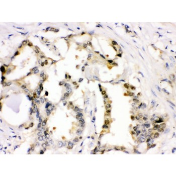 CDK2 Antibody - Cdk2 antibody IHC-paraffin. IHC(P): Human Lung Cancer Tissue.