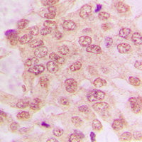 CDK2 Antibody - Immunohistochemical analysis of CDK2 staining in human lung cancer formalin fixed paraffin embedded tissue section. The section was pre-treated using heat mediated antigen retrieval with sodium citrate buffer (pH 6.0). The section was then incubated with the antibody at room temperature and detected using an HRP conjugated compact polymer system. DAB was used as the chromogen. The section was then counterstained with hematoxylin and mounted with DPX.