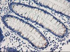 CDK2 Antibody - IHC of paraffin-embedded Adenocarcinoma of Human breast tissue using anti-CDK2 mouse monoclonal antibody.