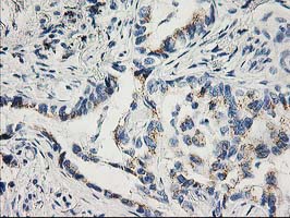 CDK2 Antibody - IHC of paraffin-embedded Carcinoma of Human lung tissue using anti-CDK2 mouse monoclonal antibody.