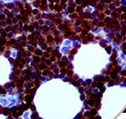 CDK2 Antibody - IHC of CDK2 on FFPE Lymphoblastic Lymphoma Tissue.