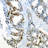 CDK2 Antibody - Immunohistochemical analysis of CDK2 staining in human colon cancer formalin fixed paraffin embedded tissue section. The section was pre-treated using heat mediated antigen retrieval with sodium citrate buffer (pH 6.0). The section was then incubated with the antibody at room temperature and detected using an HRP conjugated compact polymer system. DAB was used as the chromogen. The section was then counterstained with hematoxylin and mounted with DPX.