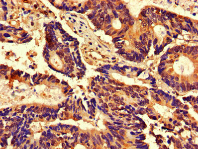 CDK2 Antibody - IHC image of CDK2 Antibody diluted at 1:800 and staining in paraffin-embedded human colon cancer performed on a Leica BondTM system. After dewaxing and hydration, antigen retrieval was mediated by high pressure in a citrate buffer (pH 6.0). Section was blocked with 10% normal goat serum 30min at RT. Then primary antibody (1% BSA) was incubated at 4°C overnight. The primary is detected by a biotinylated secondary antibody and visualized using an HRP conjugated SP system.