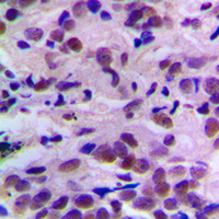CDK2 Antibody - Immunohistochemical analysis of CDK2 (pT160) staining in human breast cancer formalin fixed paraffin embedded tissue section. The section was pre-treated using heat mediated antigen retrieval with sodium citrate buffer (pH 6.0). The section was then incubated with the antibody at room temperature and detected using an HRP conjugated compact polymer system. DAB was used as the chromogen. The section was then counterstained with hematoxylin and mounted with DPX.