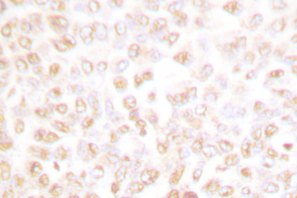 CDK2 Antibody - IHC of CDK2/CDC2 (V154) pAb in paraffin-embedded human breast carcinoma tissue.