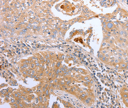 CDK20 / CCRK Antibody - Immunohistochemistry of paraffin-embedded human lung cancer tissue.