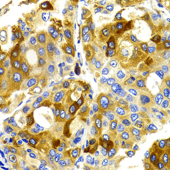 CDK20 / CCRK Antibody - Immunohistochemistry of paraffin-embedded liver cancer tissue.