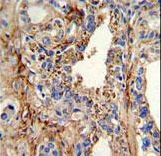 CDK4 Antibody - Formalin-fixed and paraffin-embedded human prostate carcinoma with CDK4 Antibody , which was peroxidase-conjugated to the secondary antibody, followed by DAB staining. This data demonstrates the use of this antibody for immunohistochemistry; clinical relevance has not been evaluated.
