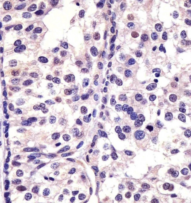 CDK4 Antibody - Antibody staining CDK4 in human breast carcinoma sections by Immunohistochemistry (IHC-P - paraformaldehyde-fixed, paraffin-embedded sections). Tissue was fixed with formaldehyde and blocked with 3% BSA for 0. 5 hour at room temperature; antigen retrieval was by heat mediation with a citrate buffer (pH 6). Samples were incubated with primary antibody (1:25) for 1 hours at 37°C. A undiluted biotinylated goat polyvalent antibody was used as the secondary antibody.