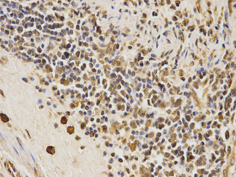 CDK4 Antibody - Immunohistochemistry of paraffin-embedded human esophageal cancer using CDK4 antibody at dilution of 1:100 (400x lens).