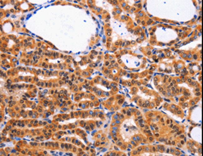 CDK4 Antibody - Immunohistochemistry of paraffin-embedded Human thyroid cancer using CDK4 Polyclonal Antibody at dilution of 1:10.