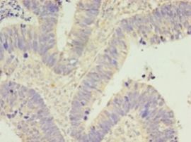 CDK5 Antibody - Immunohistochemistry of paraffin-embedded human ovarian cancer tissue using antibody at 1: 100 dilution.  This image was taken for the unconjugated form of this product. Other forms have not been tested.