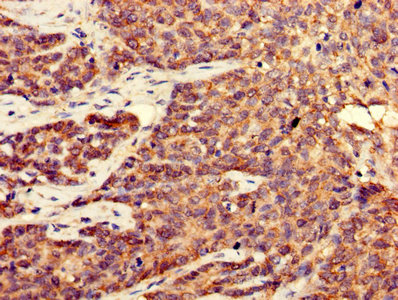CDK5 Antibody - Immunohistochemistry of paraffin-embedded human ovarian cancer using CDK5 Antibody at dilution of 1:100