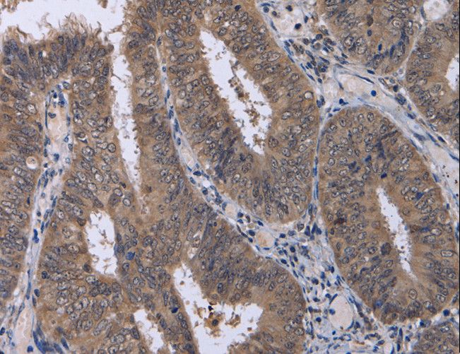 CDK5 Antibody - Immunohistochemistry of paraffin-embedded Human colon cancer using CDK5 Polyclonal Antibody at dilution of 1:30.