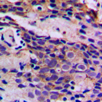 CDK5 Antibody - Immunohistochemical analysis of CDK5 (pY15) staining in human breast cancer formalin fixed paraffin embedded tissue section. The section was pre-treated using heat mediated antigen retrieval with sodium citrate buffer (pH 6.0). The section was then incubated with the antibody at room temperature and detected using an HRP conjugated compact polymer system. DAB was used as the chromogen. The section was then counterstained with hematoxylin and mounted with DPX. w