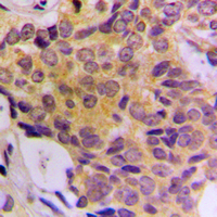 CDK5RAP3 Antibody - Immunohistochemical analysis of CDK5RAP3 staining in human breast cancer formalin fixed paraffin embedded tissue section. The section was pre-treated using heat mediated antigen retrieval with sodium citrate buffer (pH 6.0). The section was then incubated with the antibody at room temperature and detected using an HRP conjugated compact polymer system. DAB was used as the chromogen. The section was then counterstained with hematoxylin and mounted with DPX.