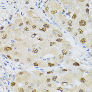 CDK6 Antibody - Immunohistochemistry of paraffin-embedded human breast cancer using CDK6 antibodyat dilution of 1:100 (40x lens).