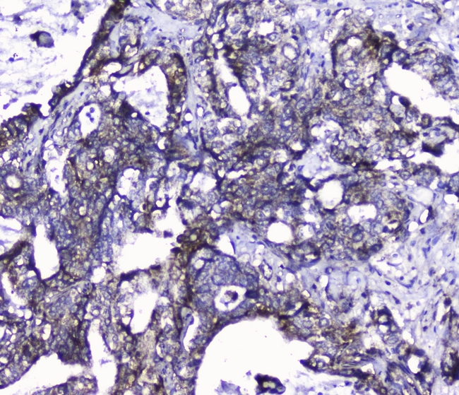 CDK6 Antibody - IHC analysis of Cdk6 using anti-Cdk6 antibody. Cdk6 was detected in paraffin-embedded section of human intestinal cancer tissues. Heat mediated antigen retrieval was performed in citrate buffer (pH6, epitope retrieval solution) for 20 mins. The tissue section was blocked with 10% goat serum. The tissue section was then incubated with 2µg/ml rabbit anti-Cdk6 Antibody overnight at 4°C. Biotinylated goat anti-rabbit IgG was used as secondary antibody and incubated for 30 minutes at 37°C. The tissue section was developed using Strepavidin-Biotin-Complex (SABC) with DAB as the chromogen.