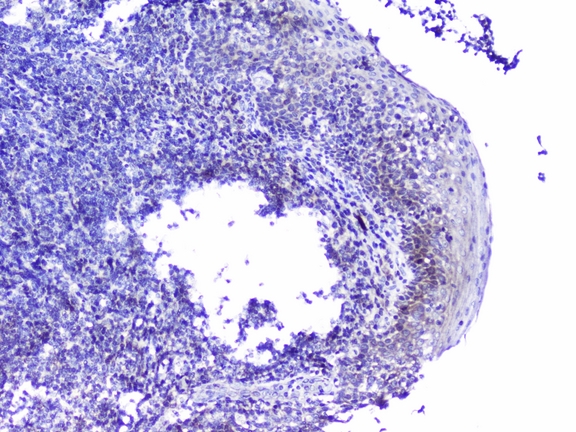 CDK6 Antibody - IHC analysis of Cdk6 using anti-Cdk6 antibody. Cdk6 was detected in paraffin-embedded section of human tonsil tissues. Heat mediated antigen retrieval was performed in citrate buffer (pH6, epitope retrieval solution) for 20 mins. The tissue section was blocked with 10% goat serum. The tissue section was then incubated with 2µg/ml rabbit anti-Cdk6 Antibody overnight at 4°C. Biotinylated goat anti-rabbit IgG was used as secondary antibody and incubated for 30 minutes at 37°C. The tissue section was developed using Strepavidin-Biotin-Complex (SABC) with DAB as the chromogen.