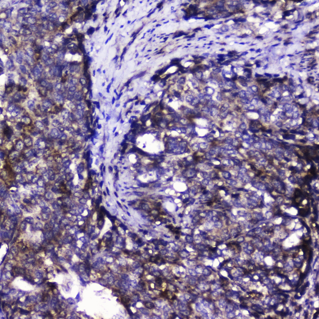 CDK6 Antibody - IHC analysis of Cdk6 using anti-Cdk6 antibody. Cdk6 was detected in paraffin-embedded section of human intestinal cancer tissue. Heat mediated antigen retrieval was performed in citrate buffer (pH6, epitope retrieval solution) for 20 mins. The tissue section was blocked with 10% goat serum. The tissue section was then incubated with 2?g/ml rabbit anti-Cdk6 Antibody overnight at 4?C. Biotinylated goat anti-rabbit IgG was used as secondary antibody and incubated for 30 minutes at 37?C. The tissue section was developed using Strepavidin-Biotin-Complex (SABC) with DAB as the chromogen.