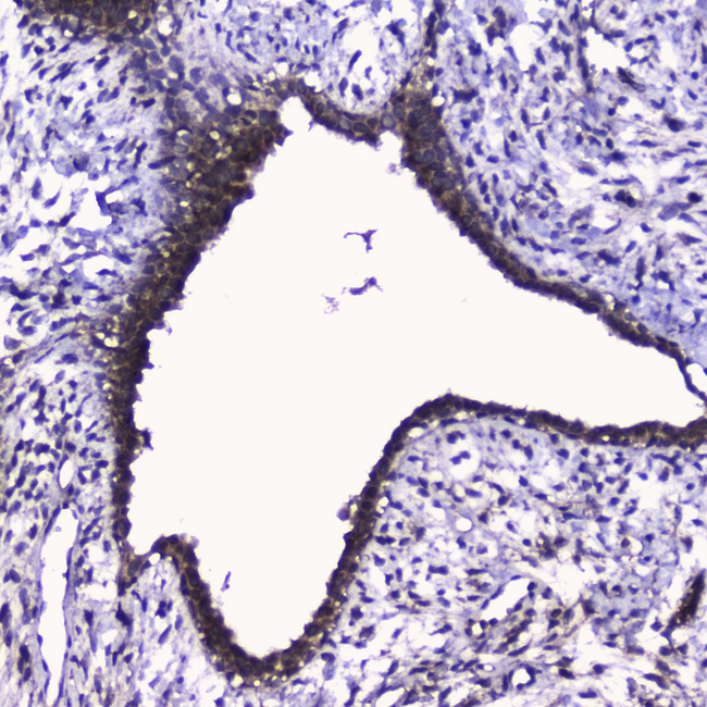 CDK6 Antibody - IHC analysis of Cdk6 using anti-Cdk6 antibody. Cdk6 was detected in paraffin-embedded section of human mammary cancer tissue. Heat mediated antigen retrieval was performed in citrate buffer (pH6, epitope retrieval solution) for 20 mins. The tissue section was blocked with 10% goat serum. The tissue section was then incubated with 2?g/ml rabbit anti-Cdk6 Antibody overnight at 4?C. Biotinylated goat anti-rabbit IgG was used as secondary antibody and incubated for 30 minutes at 37?C. The tissue section was developed using Strepavidin-Biotin-Complex (SABC) with DAB as the chromogen.