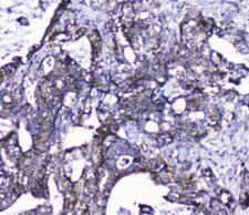 CDK6 Antibody - IHC staining of FFPE human intestinal cancer with Cdk6 antibody at 1ug/ml. HIER: boil tissue sections in pH6, 10mM citrate buffer, for 10-20 min followed by cooling at RT for 20 min.