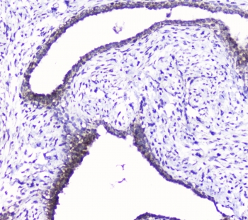 CDK6 Antibody - IHC staining of FFPE human breast cancer with Cdk6 antibody at 1ug/ml. HIER: boil tissue sections in pH6, 10mM citrate buffer, for 10-20 min followed by cooling at RT for 20 min.