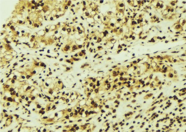 CDK6 Antibody - 1:100 staining human breast carcinoma tissue by IHC-P. The sample was formaldehyde fixed and a heat mediated antigen retrieval step in citrate buffer was performed. The sample was then blocked and incubated with the antibody for 1.5 hours at 22°C. An HRP conjugated goat anti-rabbit antibody was used as the secondary.