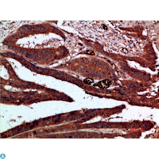 CDK6 Antibody - Immunohistochemical analysis of paraffin-embedded human-colon-cancer, antibody was diluted at 1:200.