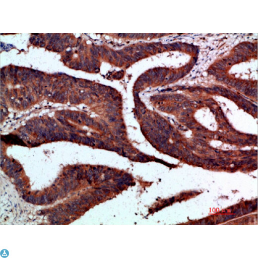 CDK6 Antibody - Immunohistochemical analysis of paraffin-embedded human-colon-cancer, antibody was diluted at 1:200.