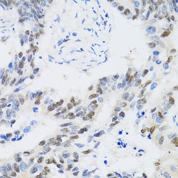 CDK6 Antibody - Immunohistochemistry of paraffin-embedded Human colon carcinoma using CDK6 Polyclonal Antibody at dilution of 1:100 (40x lens).