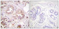 CDK7 Antibody - Immunohistochemistry analysis of paraffin-embedded human breast carcinoma tissue, using CDK7 Antibody. The picture on the right is blocked with the synthesized peptide.