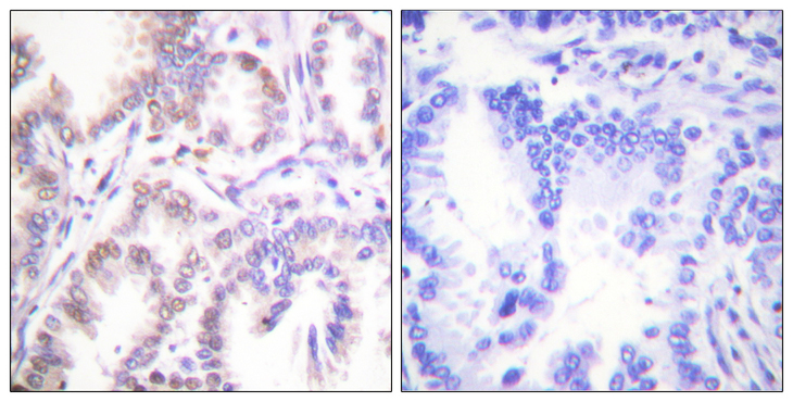 CDK7 Antibody - Immunohistochemistry analysis of paraffin-embedded human lung carcinoma tissue, using CDK7 Antibody. The picture on the right is blocked with the synthesized peptide.