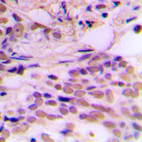 CDK7 Antibody - Immunohistochemical analysis of CDK7 staining in human breast cancer formalin fixed paraffin embedded tissue section. The section was pre-treated using heat mediated antigen retrieval with sodium citrate buffer (pH 6.0). The section was then incubated with the antibody at room temperature and detected using an HRP conjugated compact polymer system. DAB was used as the chromogen. The section was then counterstained with hematoxylin and mounted with DPX.