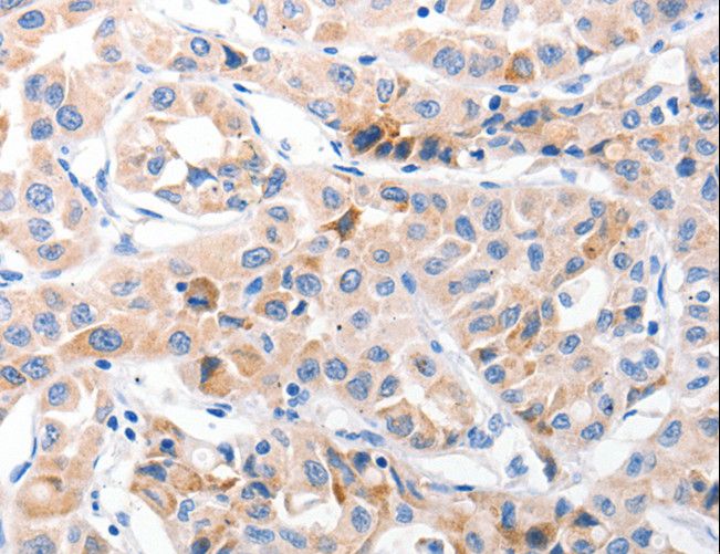 CDK7 Antibody - Immunohistochemistry of paraffin-embedded Human lung cancer using CDK7 Polyclonal Antibody at dilution of 1:30.