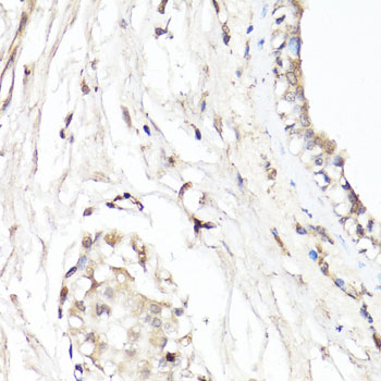 CDK7 Antibody - Immunohistochemistry of paraffin-embedded human breast using CDK7 antibody at dilution of 1:150 (40x lens).