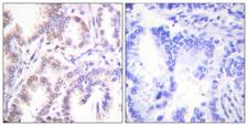 CDK7 Antibody - Peptide - + Immunohistochemistry analysis of paraffin-embedded human lung carcinoma tissue using CDK7 antibody.