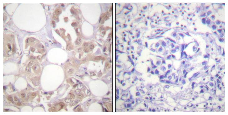 CDK7 Antibody - Immunohistochemistry analysis of paraffin-embedded human breast carcinoma, using CDK7 (Phospho-Thr170) Antibody. The picture on the right is blocked with the phospho peptide.