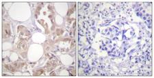 CDK7 Antibody - Immunohistochemistry analysis of paraffin-embedded human breast carcinoma, using CDK7 (Phospho-Thr170) Antibody. The picture on the right is blocked with the phospho peptide.