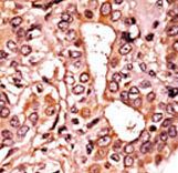 CDK7 Antibody - Formalin-fixed and paraffin-embedded human cancer tissue reacted with the primary antibody, which was peroxidase-conjugated to the secondary antibody, followed by AEC staining. This data demonstrates the use of this antibody for immunohistochemistry; clinical relevance has not been evaluated. BC = breast carcinoma; HC = hepatocarcinoma.