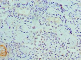 CDK8 Antibody - Immunohistochemistry of paraffin-embedded human breast cancer using antibody at 1:100 dilution.