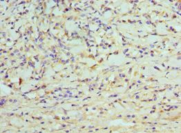 CDK8 Antibody - Immunohistochemistry of paraffin-embedded human gastric cancer using antibody at 1:100 dilution.