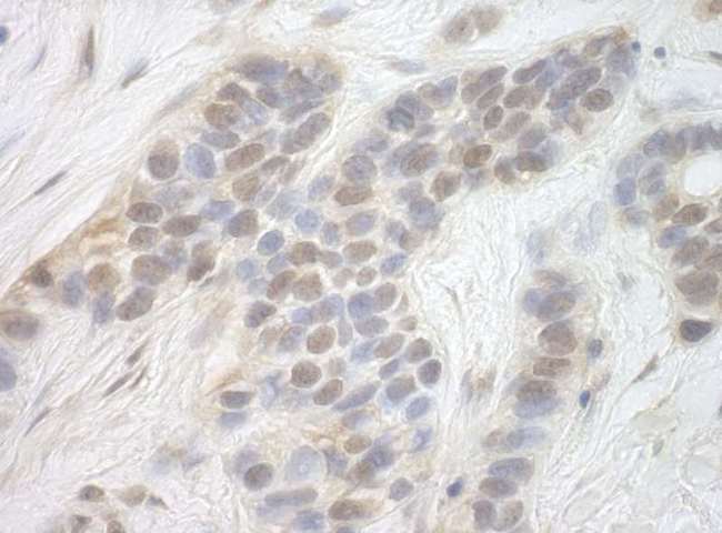 CDK8 Antibody - Detection of Human CDK8 by Immunohistochemistry. Sample: FFPE section of human breast carcinoma. Antibody: Affinity purified rabbit anti-CDK8 used at a dilution of 1:250.