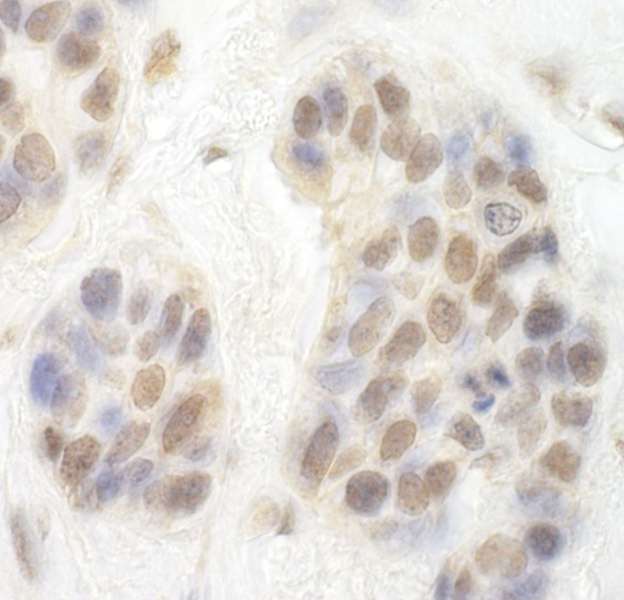 CDK8 Antibody - Detection of Human CDK8 by Immunohistochemistry. Sample: FFPE section of human breast carcinoma. Antibody: Affinity purified rabbit anti-CDK8 used at a dilution of 1:200 (1 ug/ml).