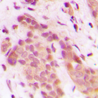 CDK8 Antibody - Immunohistochemical analysis of CDK8 staining in human breast cancer formalin fixed paraffin embedded tissue section. The section was pre-treated using heat mediated antigen retrieval with sodium citrate buffer (pH 6.0). The section was then incubated with the antibody at room temperature and detected using an HRP conjugated compact polymer system. DAB was used as the chromogen. The section was then counterstained with hematoxylin and mounted with DPX.