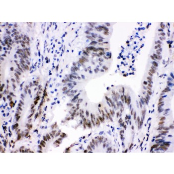 CDK9 Antibody - Cdk9 antibody IHC-paraffin. IHC(P): Human Intestinal Cancer Tissue.