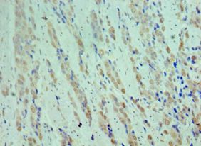 CDK9 Antibody - Immunohistochemistry of paraffin-embedded human rectal cancer using antibody at 1:100 dilution.